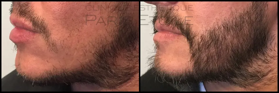 Greffe de barbe avant après